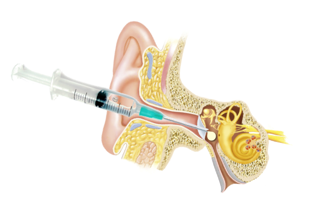 Intratympanic Injection(Ear) Under Microscope